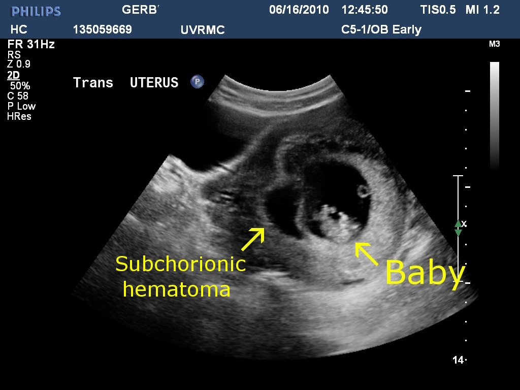 Subchorionic Hemorrhage Definition Diagnosis And Treatments New Kids
