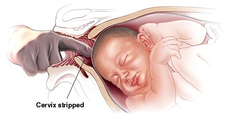 Inducing Labor by Membrane Stripping