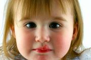 Cold Sores in Toddlers