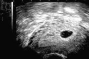 What to Expect with Ultrasound in 5-Week Pregnancy