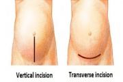 How Long Does It Take to Recover from a C-section?