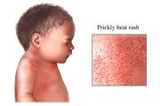 Heat Rash in Toddler