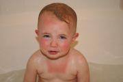 Baby Sunburn: Natural Treatment & Prevention