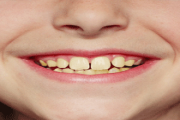 My Child’s Teeth Are Yellow