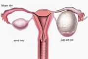 Ovarian Cyst When Pregnant: Signs & Treatments