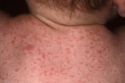 Roseola in Baby