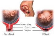 What Does Effacement Mean?