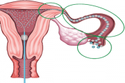 How Is a HSG Test Performed?