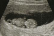 Ultrasound at 8 Weeks: What to Expect
