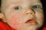 Viral Rashes in Children: Causes, Symptoms & Treatments