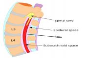 Difference Between Epidural And Spinal Block