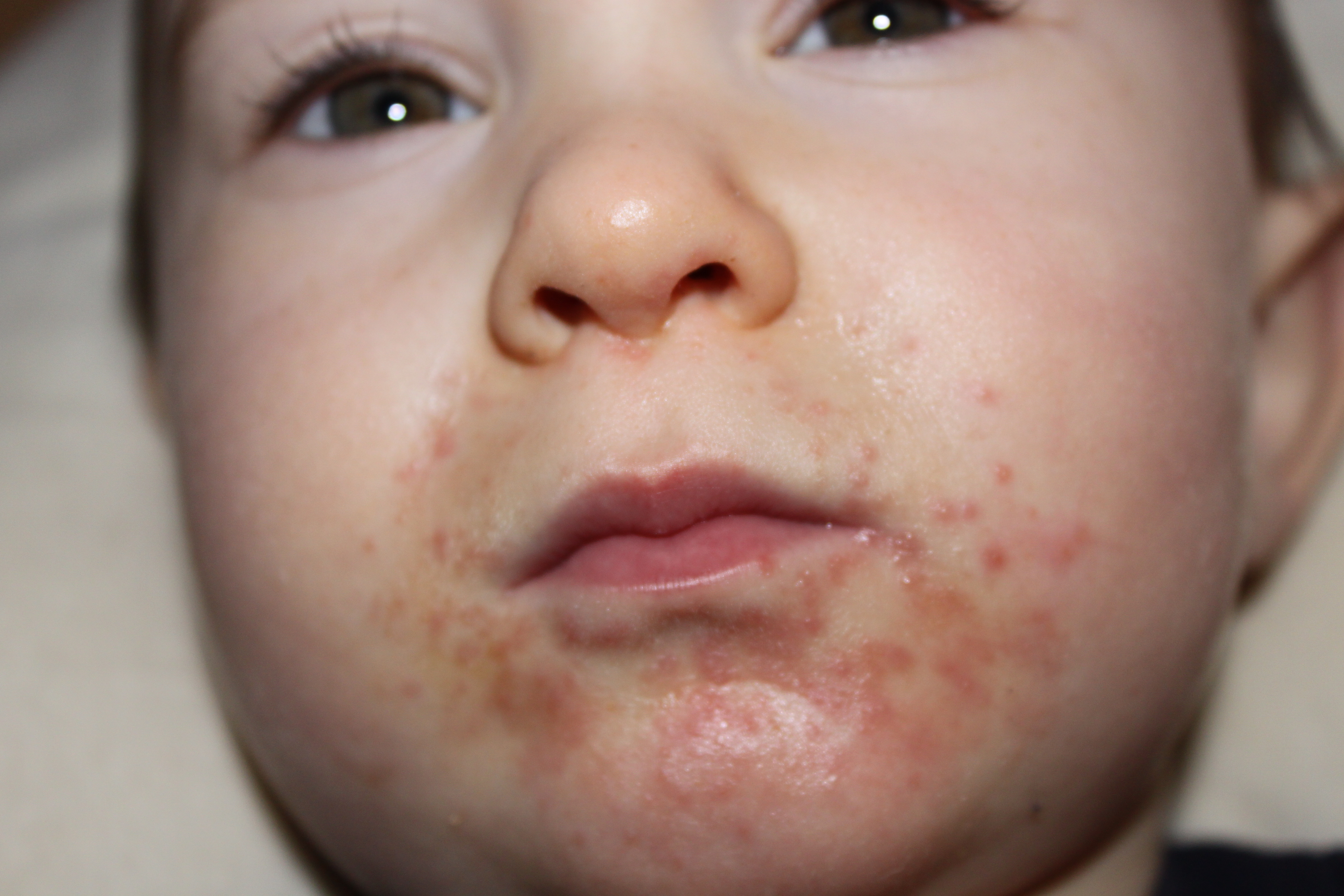 Rash Bumps On Face Pictures Photos