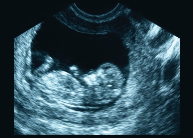 baby measuring small at 7 weeks no heartbeat