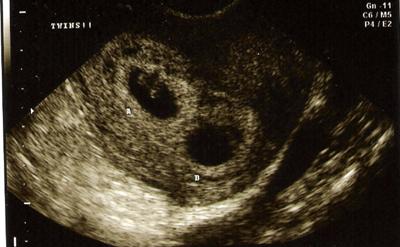 For twins ultrasound Multiple Pregnancy