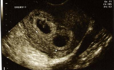 Twins ultrasound for Twin pregnancy