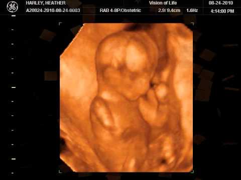 What To Expect In Ultrasound Done At 15 Weeks Pregnant New Kids Center