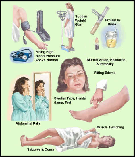 high blood pressure symptoms during pregnancy)