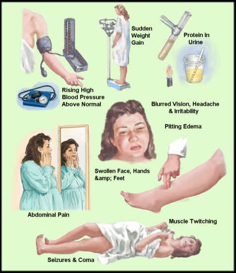 What's Preeclampsia Swelling Like? What 